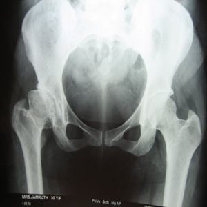 Hip Arthritis
